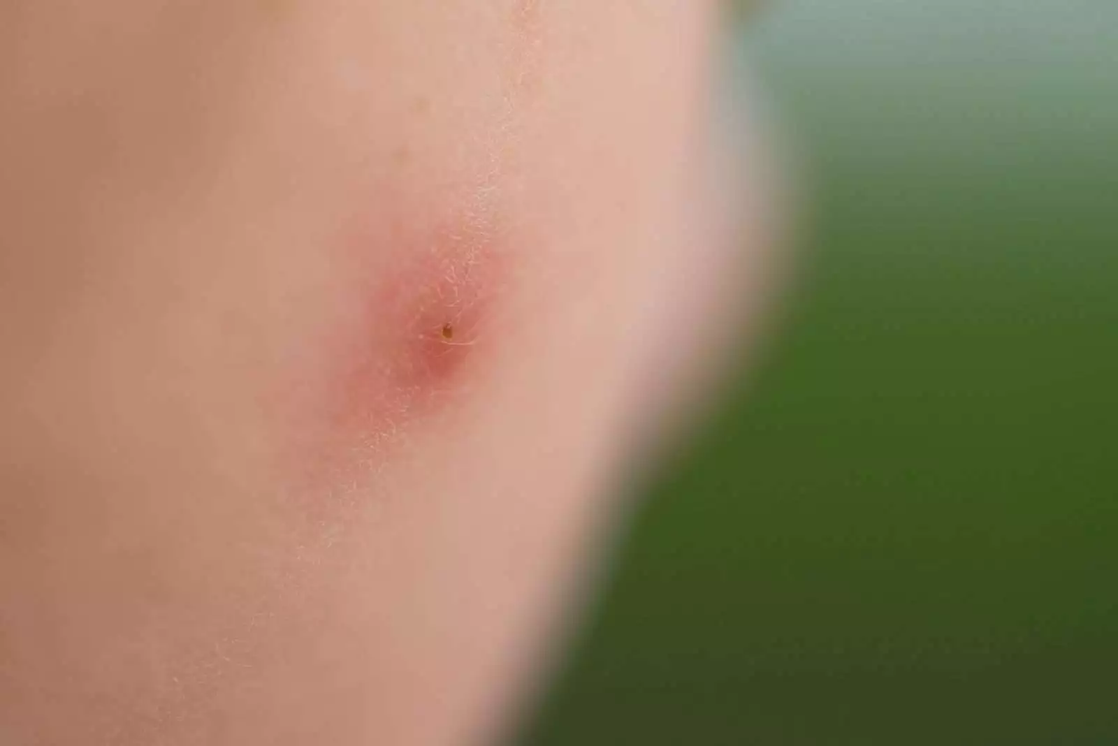 Bed Bug bites vs Mosquito bites